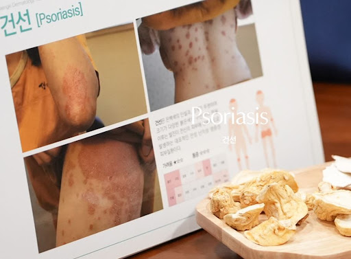 생기한의원이 안내하는 건선 홍반과 인설 확인 정보