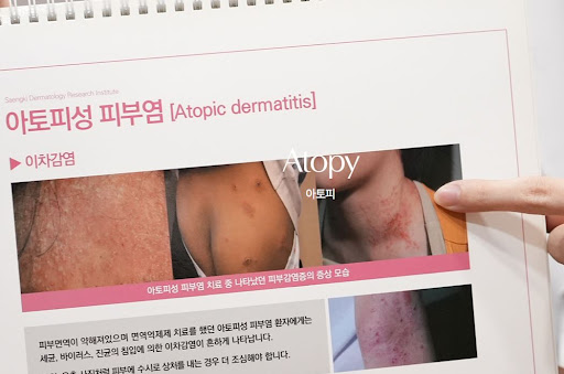 생기한의원으로 확인하는 아토피 초기증상과 피부 변화